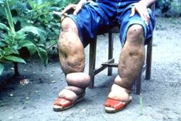 KAPFI : memberantas penyakit kaki gajah