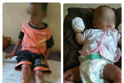 Penyakit yang diderita kakak beradik di Tambangan akibat virus Toxoplasma