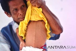 Bocah 2,5 tahun di Tapsel diduga alami gizi buruk