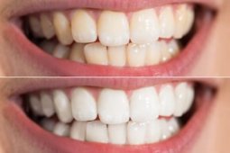 Spesialis: Prosedur "bleaching" tidak berlaku untuk semua orang
