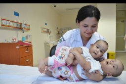 Bayi kembar siam lahir di Medan