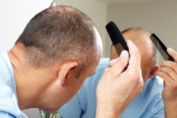 Hal ini penyebab kebotakan