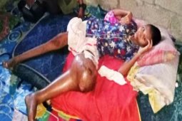 Siti Aisyah warga Sei Bilah Langkat butuh bantuan untuk pengobatan tumor di kakiny