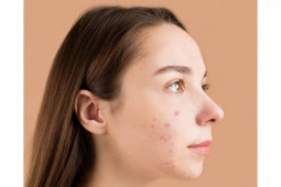 Dokter sampaikan tip mengenali tanda ketidakcocokan perawatan wajah