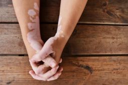 Waspada, autoimun menyerang kulit