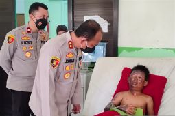 Kapolres Bangka Selatan beri semangat anak alami luka bakar