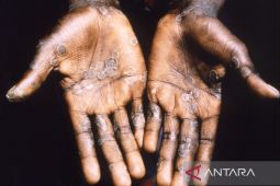 WHO laporkan 3.200 lebih kasus cacar monyet satu kematian  secara global