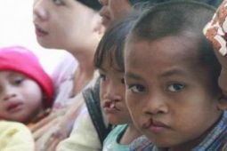 Dokter spesialis sebut, prosedur bedah lebih awal justru selamatkan psikis anak kelainan bibir sumbing