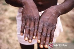 WHO ubah nama cacar monyet jadi "mpox"