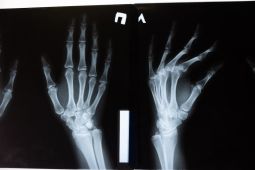 Perempuan di atas 50 tahun lebih rentan terkena osteoporosis