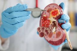 Hati-hati konsumsi obat sembarangan, bisa picu gagal ganjil