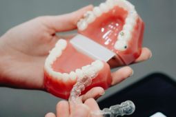 Kelebihan "clear aligners" dibandingkan kawat gigi