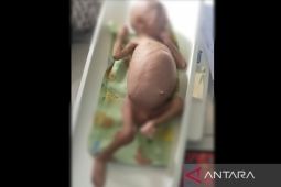 Dinkes Karawang tangani seorang bayi alami gizi buruk
