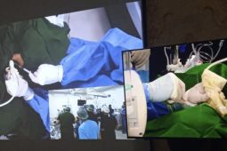 Kembar siam Aliah dan Afifah kini telah terpisah dan mandiri