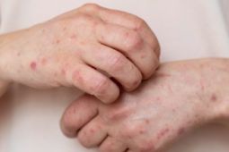 Di Papua Tengah , 34 orang dirawat akibat campak dan rubela