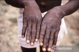 Dua pasien Mpox di Tangerang Selatan telah diisolasi
