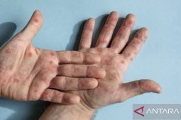 Mpox di Indonesia 38 kasus, terbaru dari Kota Cirebon