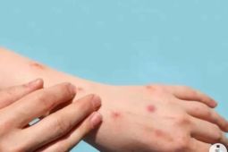 Ini karakteristik ruam klinis yang sering dijumpai pada penderita Mpox