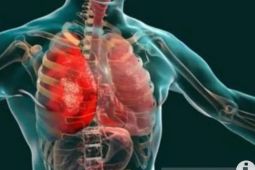 Jakarta Health Agency informs of ways to prevent mycoplasma pneumonia