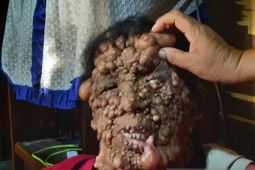 Tubuh penuh benjolan, anak petani asal Padang Lawas Utara ini butuh perhatian