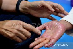 Dokter: Autoimun bukanlah penyakit menular