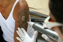 Layanan hapus tato gratis