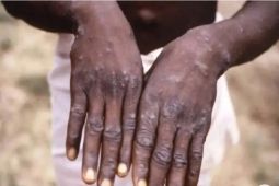 Zimbabwe mencatat dua kasus pertama virus cacar monyet