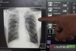 Dinkes Kota Malang sebut kolaborasi jadi strategi mengidentifikasi TBC