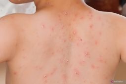 WHO: Kematian campak turun 88 persen sejak 2000 tapi kasus meningkat