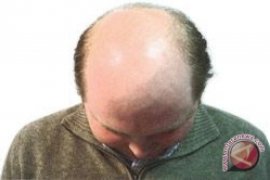 Waspadai kebotakan pada rambut, simak cara meminimalkannya