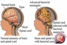 Taman Air Arkansas Ditutup Setelah Ditemukan Kasus Meningitis Langka