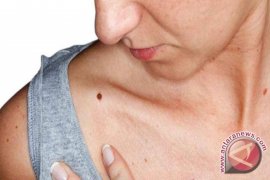 Tahi Lalat Berhubungan Dengan Risiko Kanker Payudara