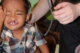  Punya Anak Bibir Sumbing? RSUD Pekanbaru Gratiskan Operasi