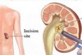 Sejumlah Blogger Dan Awak Media Riau Dapatkan Edukasi Batu Ginjal