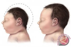 Waduh! Virus Zika Ternyata Bisa Ditularkan Melalui Air Mata