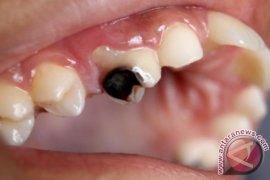 Selain obesitas dan diabetes, ini dampak lain gula berlebihan di dalam tumbuh