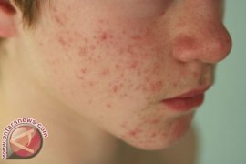 Nana Mirdad ungkap cara alami atasi jerawat