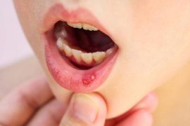 Praktisi kesehatan: polycresulen bermanfaat sembuhkan sariawan