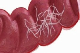 Balita Sukabumi meninggal karena cacing gelang, begini penjelasannya!