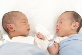 Siamese twins born in Banjarmasin Ulin Hospital
