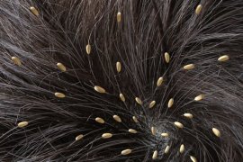 Kutu bisa picu sejumlah penyakit dan kenali cara mencegahnya 