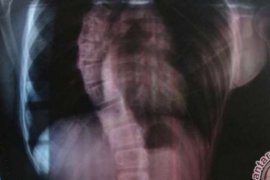 Perempuan Lebih Berisiko Tulang Punggungnya Melengkung daripada Pria, Kenapa ya?