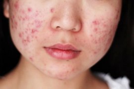 Benarkah "facial" ampuh atasi kulit berjerawat?, ini jawabannya