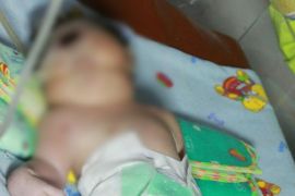 Bayi bermata satu  lahir di Panyabungan