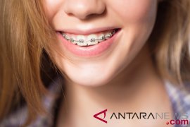 Sebelum veneer gigi, pahami jenis, kelebihan dan kekurangannya
