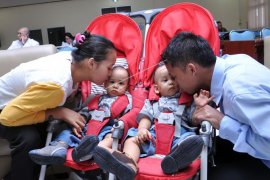 Bayi kembar siam sukses operasi pemisahan