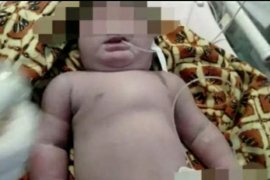 Bayi bermata satu di Siak meninggal dunia