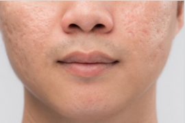 Cara efektif atasi bekas jerawat menurut dokter