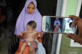 Balita penderita Limfangioma