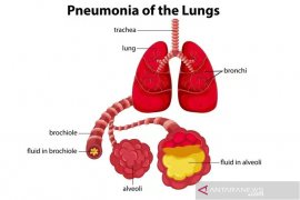Kenali gejala tidak khas pneumonia pada lansia